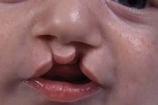 Surgeons Recommend Early Intervention to Curb Cleft Lip Complications